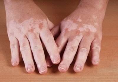 Vitiligo dan Albinisme, Apa Bedanya?      