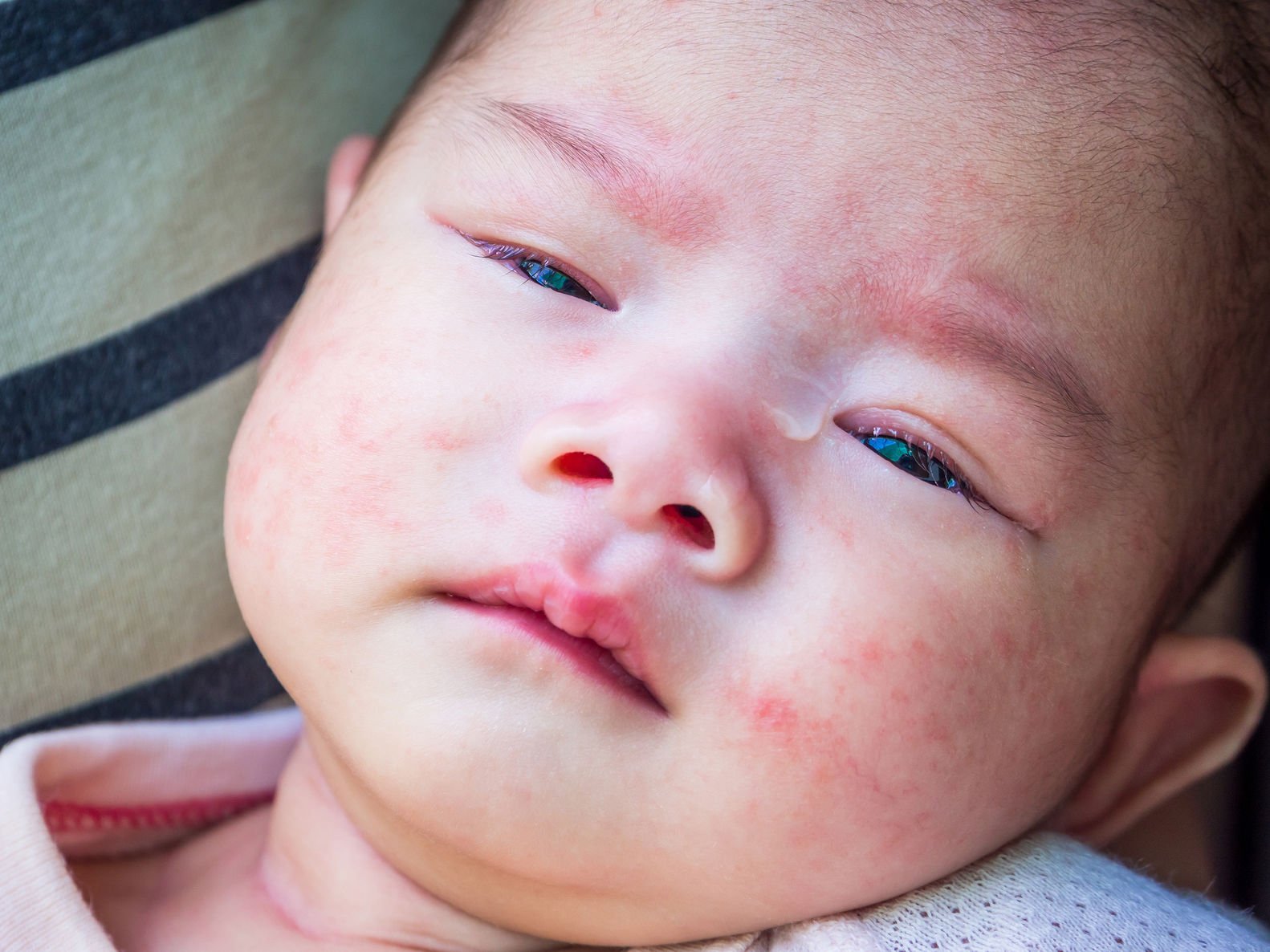 Eksim Atopik, Bisa Membuat Bayi Anda Tidak Tidur Semalaman