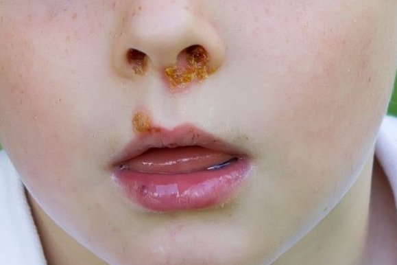 Bintil-bintil Pada Kulit Anak Belum Tentu Cacar, Bisa Jadi Impetigo