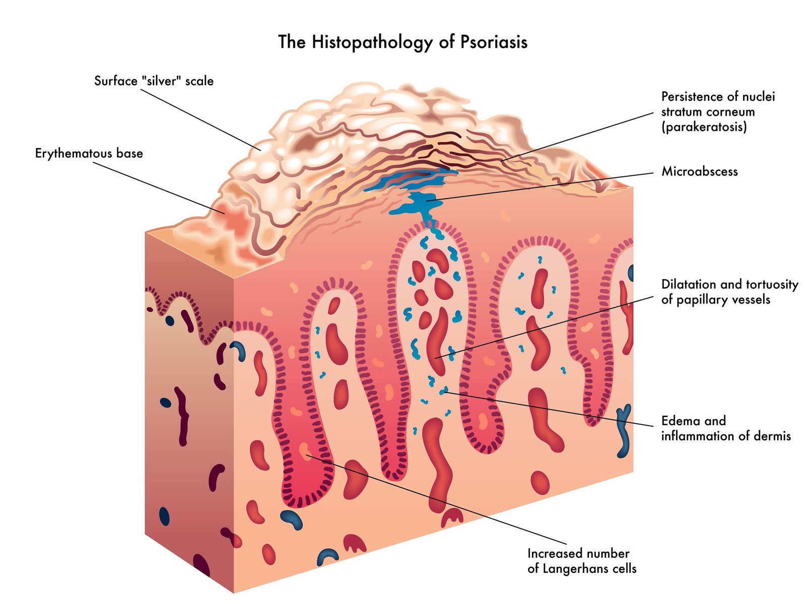 Jangan Heran Kalau Anak-Anak Juga Bisa Menderita Psoriasis